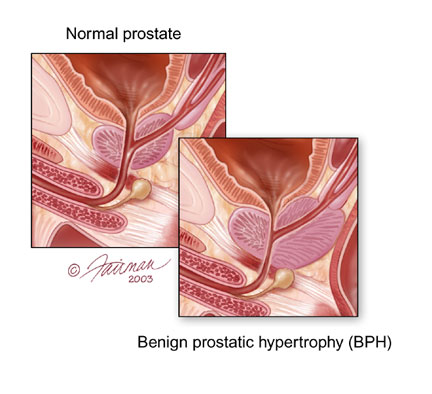 This information was provided by the Urology Care Foundation on UrologyHealth.org as of September 2013.