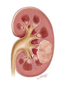 This information was provided by the Urology Care Foundation on UrologyHealth.org as of September 2013.