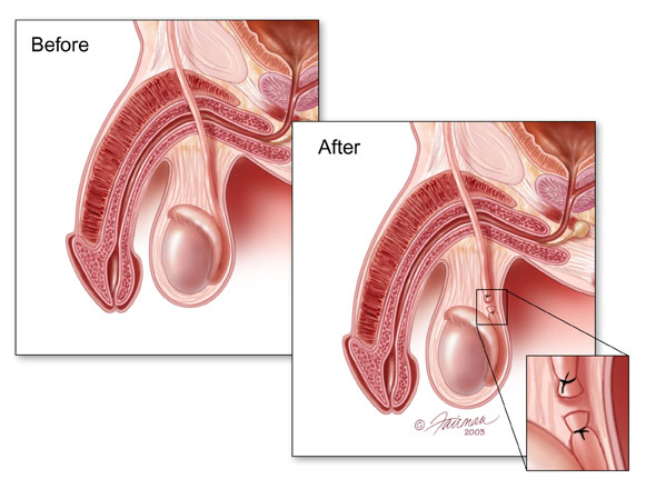 This information was provided by the Urology Care Foundation on UrologyHealth.org as of September 2013.