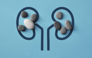 What are the symptoms of kidney stones?