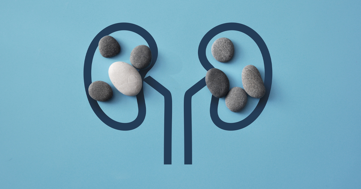 What are the symptoms of kidney stones?