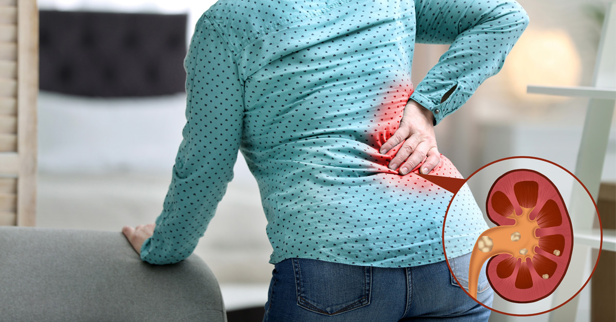 what are the first signs of kidney stones